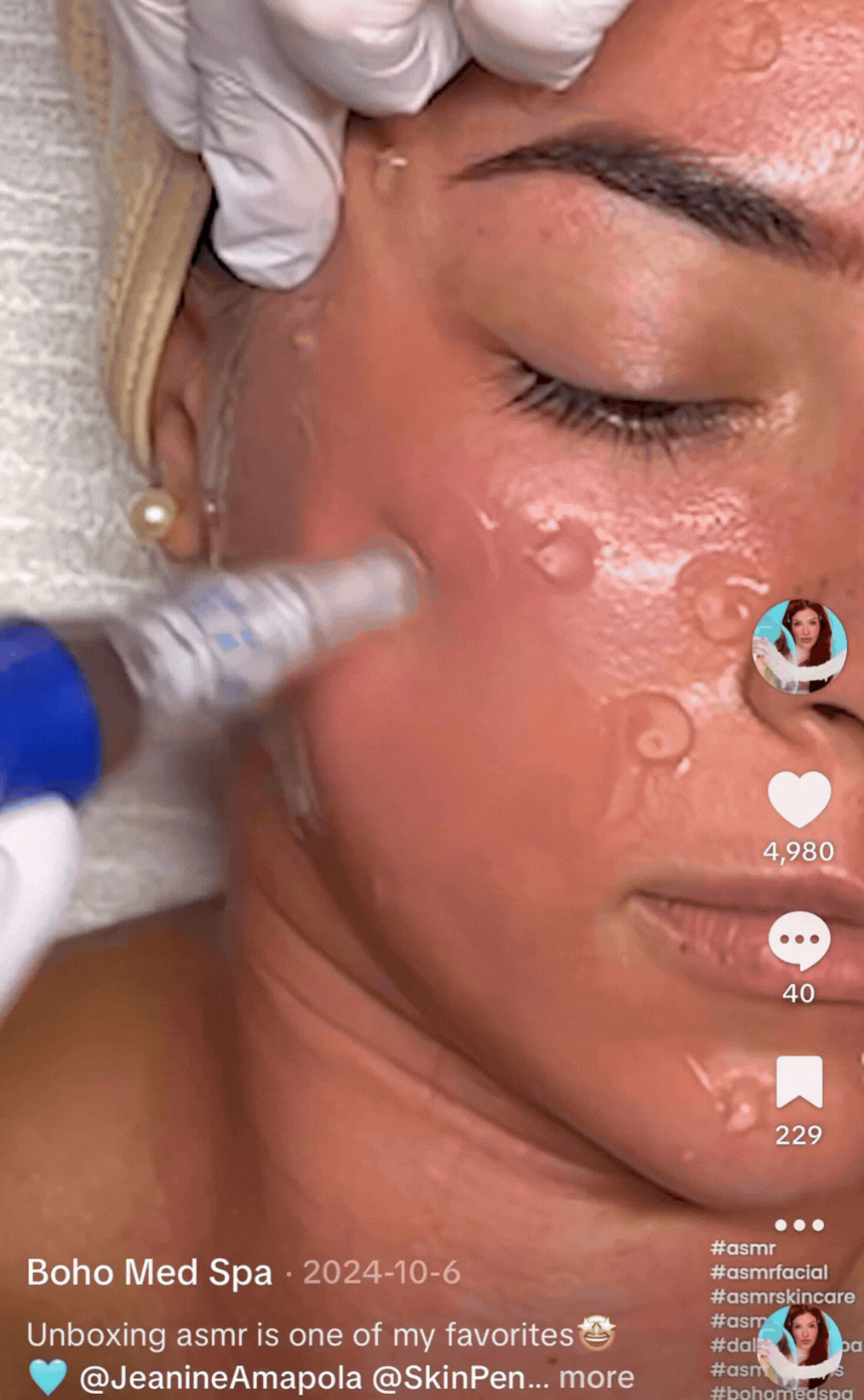 microneedling gif for customers
