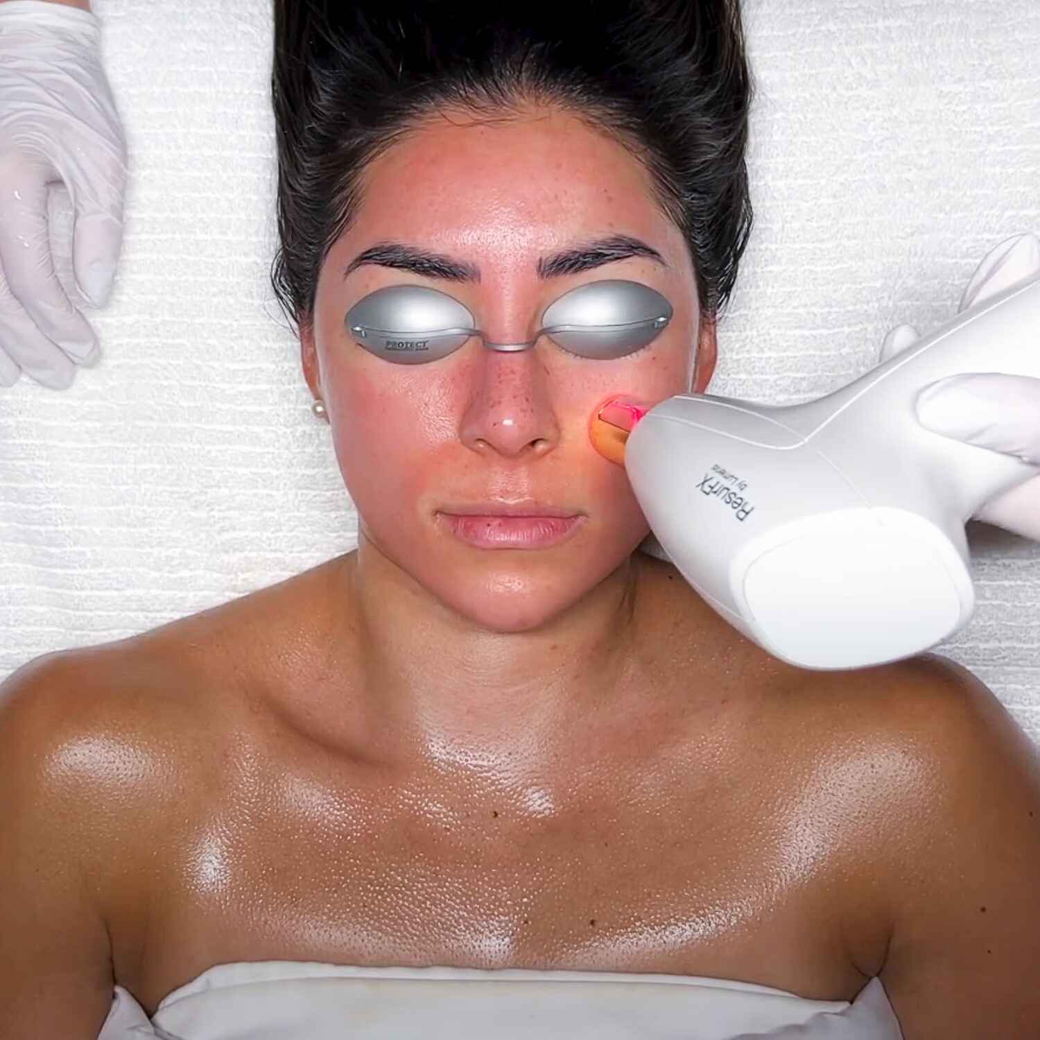 ResurFX® Laser to pair with microneedling