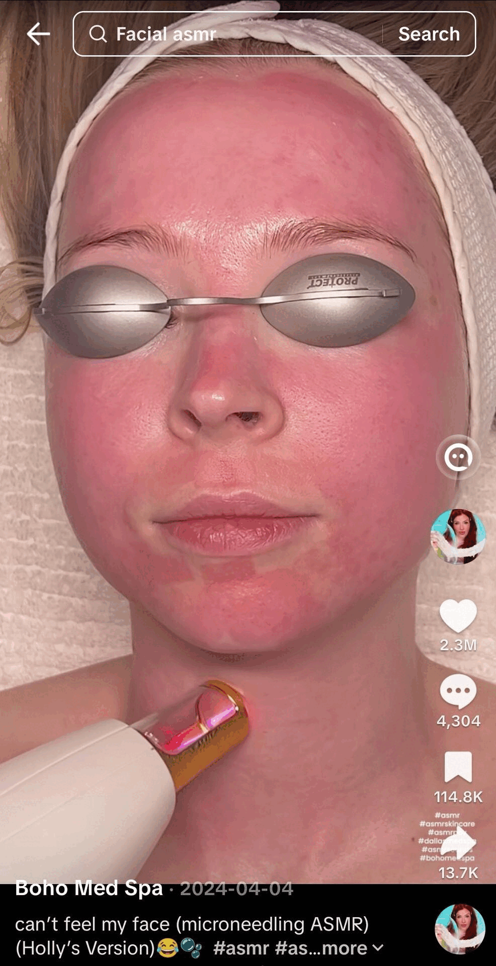 resurfx fractional laser gif for customers