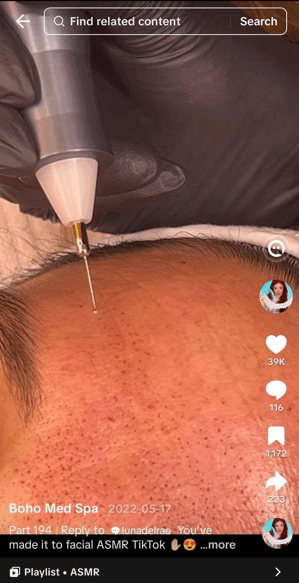 plasma skin tightening
