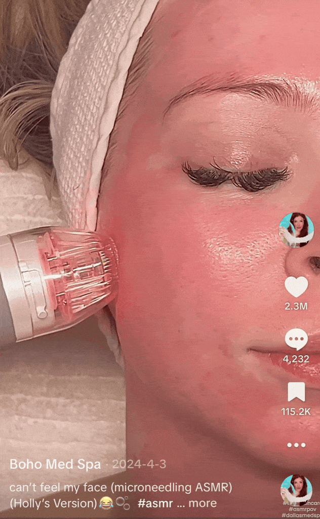 rf microneedling for customers