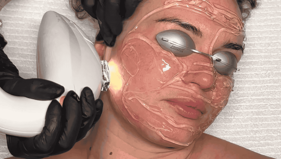 IPL Photofacial to pair with resurfx fractional laser