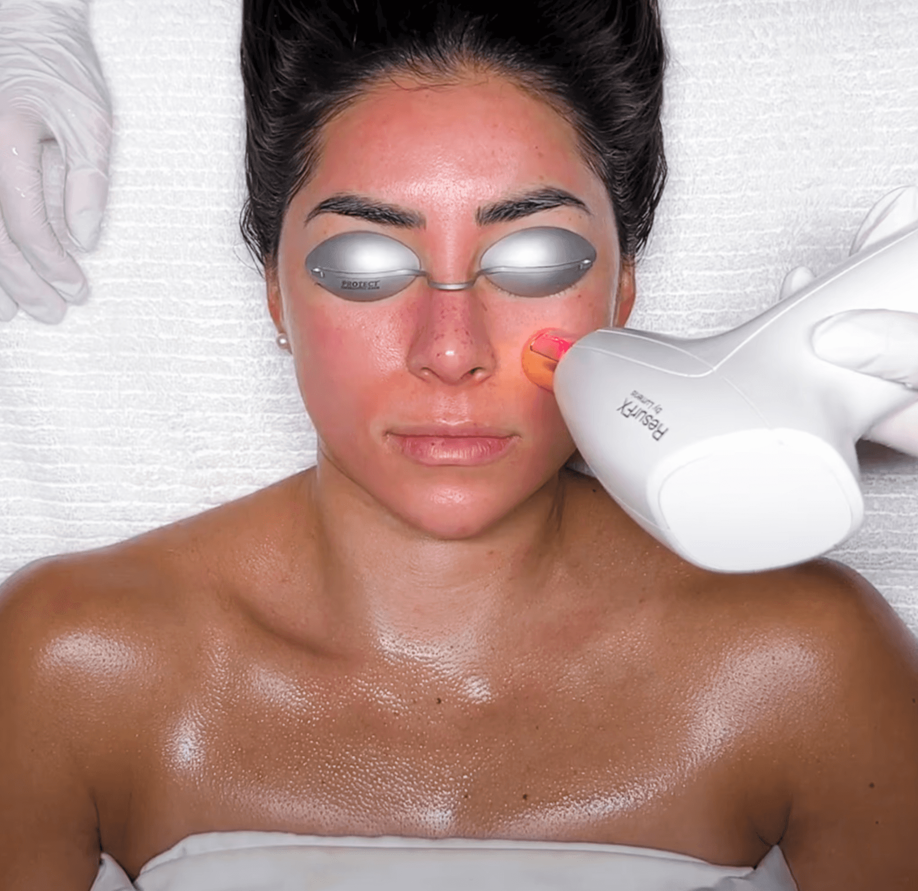 ResurFX® Laser to pair with microneedling