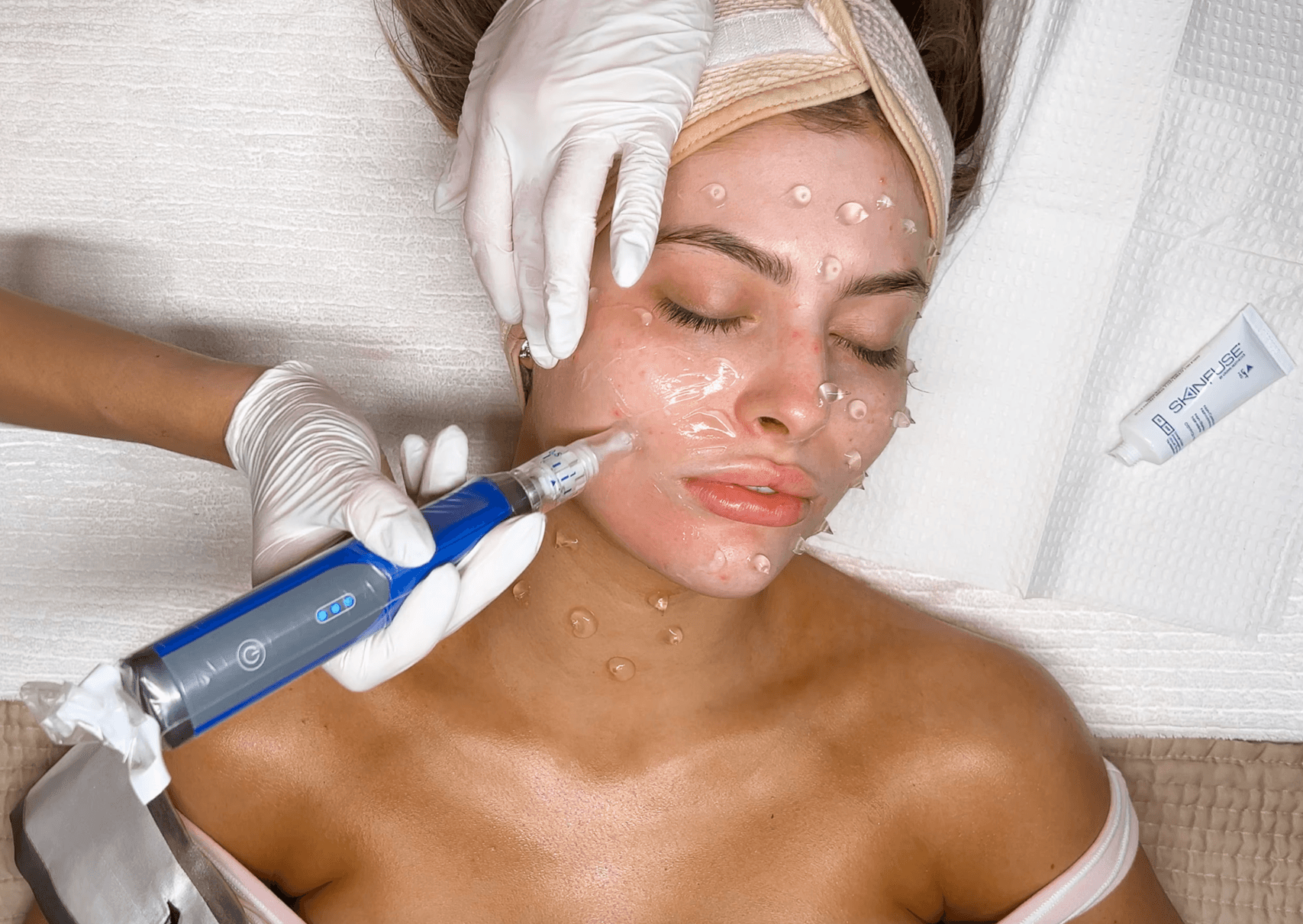Microneedling