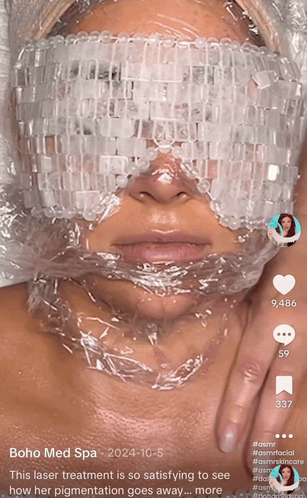resurfx fractional laser gif for customers