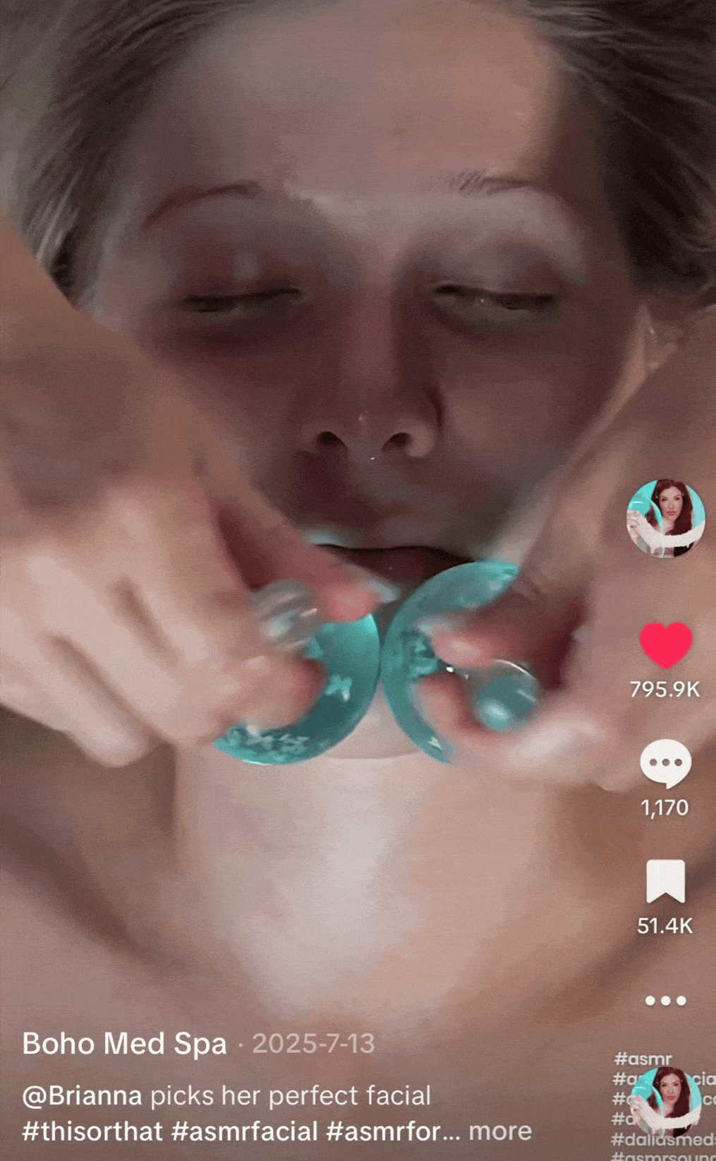 ipl photofacial gif