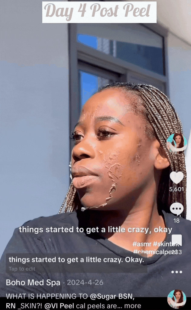 Chemical peel gif