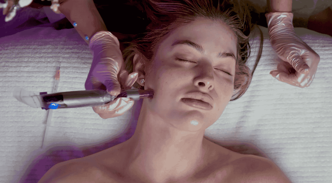 PRX WiQo® Microneedling to pair with ipl photofacial