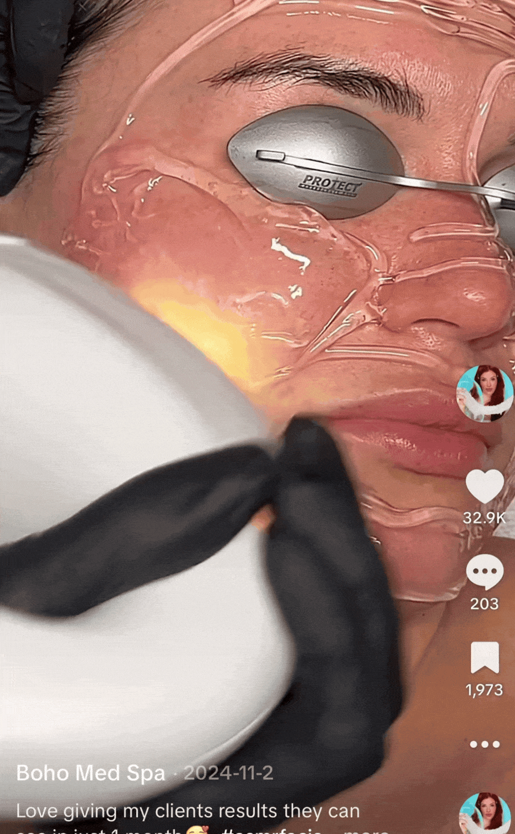 ipl photofacial gif
