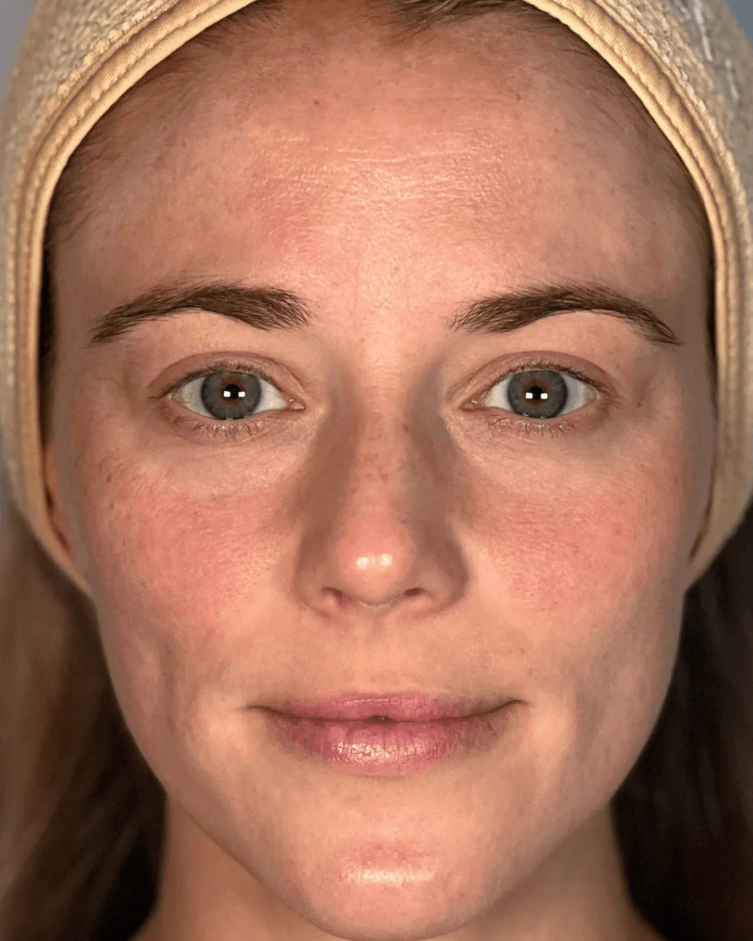Before: the guest's bare face, front view